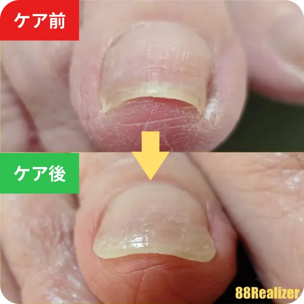 巻き爪ケアのビフォーアフター1