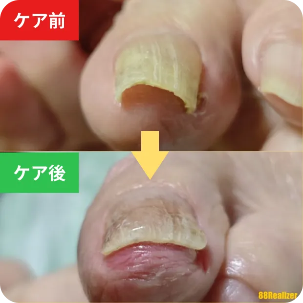 巻き爪ケアのビフォーアフター2