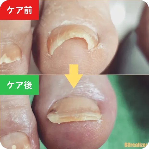 巻き爪ケアのビフォーアフター3
